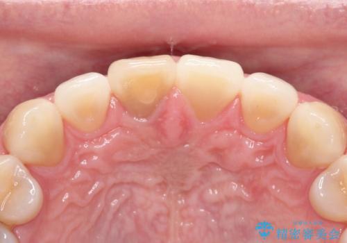 【前歯の被せ物】オールセラミッククラウン(エクセレント)の治療前