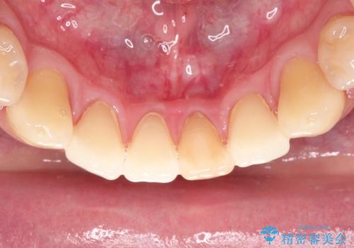 下顎前歯のセラミッククラウンの治療前