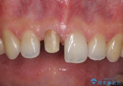 【前歯の被せ物】オールセラミッククラウン(エクセレント)の治療中