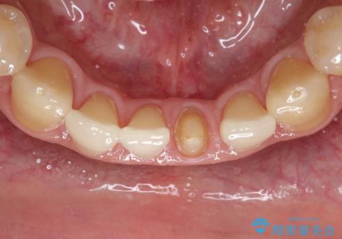 下顎前歯のセラミッククラウンの治療中