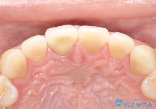 【前歯の被せ物】オールセラミッククラウン(エクセレント)の治療後