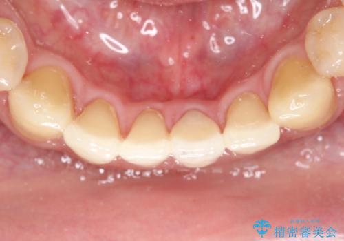 下顎前歯のセラミッククラウンの治療後