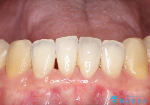 下顎前歯のセラミッククラウンの症例 治療後
