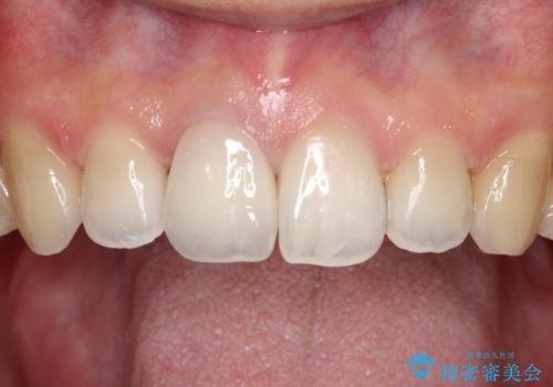 【前歯の被せ物】オールセラミッククラウン(エクセレント)の治療後