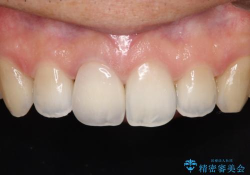 【前歯の被せ物】オールセラミッククラウン(エクセレント)