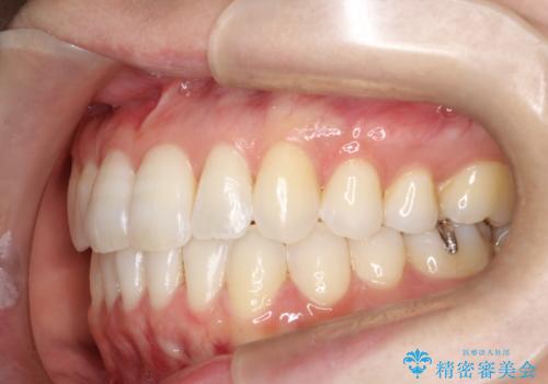 【インビザライン】前歯の凸凹をなおしたいの治療後