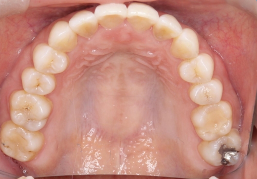 【インビザライン】前歯の凸凹をなおしたいの治療後
