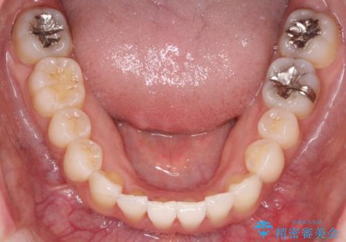 【インビザライン】前歯の凸凹をなおしたいの治療後