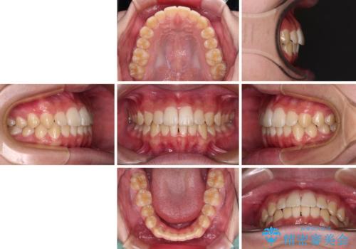 しっかり使って短期間で治療 インビザラインによる叢生解消の治療後