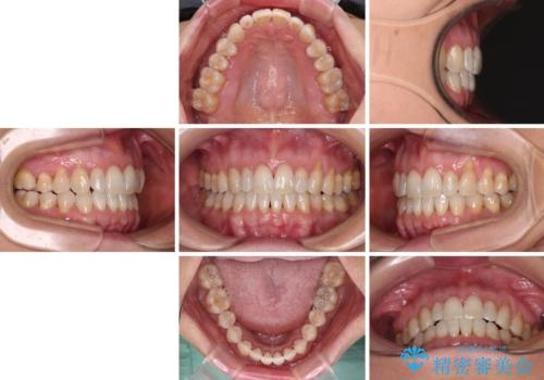 前歯のスペースが気になる インビザラインによる矯正治療の治療後