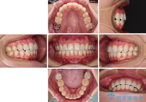 上顎の八重歯と下顎前歯の欠損 ワイヤー装置による抜歯矯正の治療後