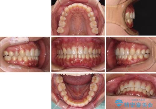 沖縄から飛行機で通院 インビザラインによる矯正治療の治療後