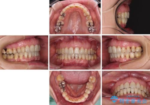 口元の出っ張りとデコボコを改善したいの治療後