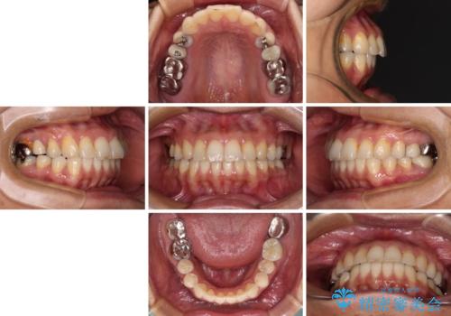 痛む奥歯と矯正の後戻り インビザライン・ライトとセラミック治療の治療後