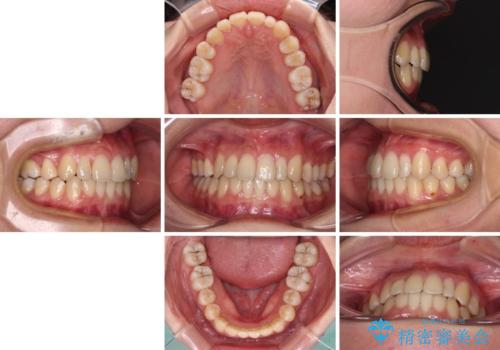 八重歯の抜歯矯正 補助装置を用いたインビザライン矯正の治療後