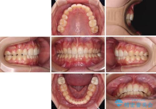 気になる八重歯を改善 補助装置併用のインビザライン治療の治療後