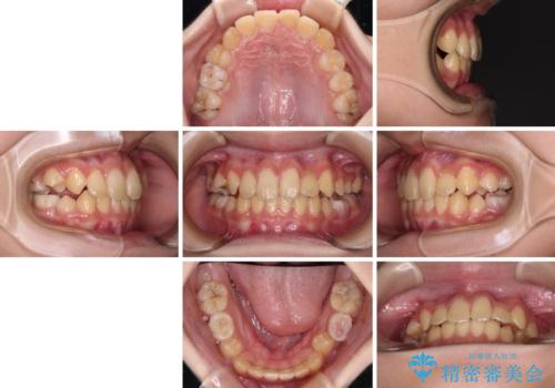 過剰歯を抜歯して前歯を排列 インビザライン・ファーストによる小学生のⅠ期治療の治療後
