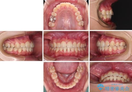 八重歯で正中が右にずれている ワイヤー装置での抜歯矯正で正中位置を改善の治療後