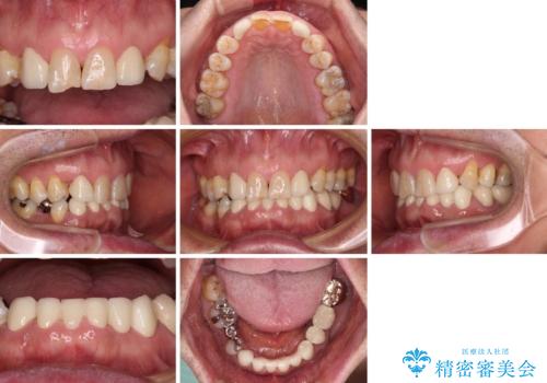 乳歯や矮小歯の多い前歯 部分矯正と補綴治療による審美歯科治療の治療後