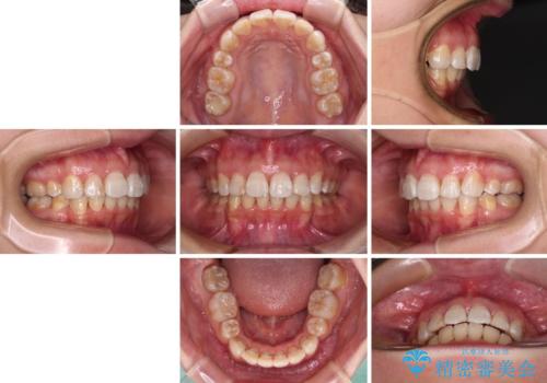 飛び出した前歯を引っ込めたい 目立たないワイヤーでの抜歯矯正の治療後
