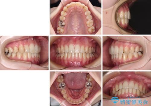 短期間での治療 急速拡大装置を併用したワイヤー装置による矯正治療の治療後