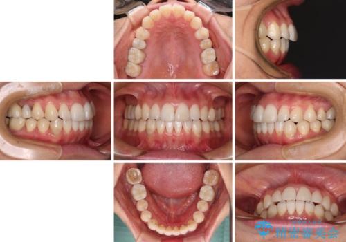 気になる前歯をインビザライン・ライトで　矯正治療後には銀歯をセラミックにの治療後