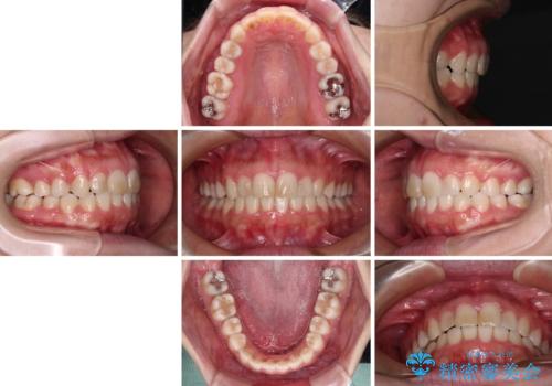 気になる前歯を治したい インビザラインで気づかれずに矯正治療の治療後