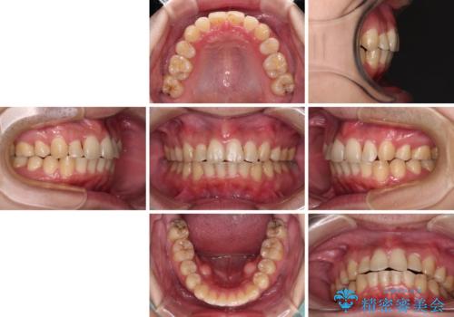 強い咬み込みですり減った前歯　デコボコを抜歯矯正で整えるの治療後