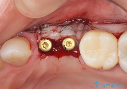 骨の造成を伴うインプラント治療の治療中