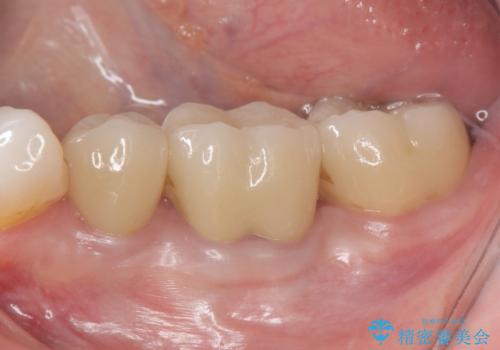 歯ぐきの腫れを改善する歯周外科手術を伴うセラミック治療