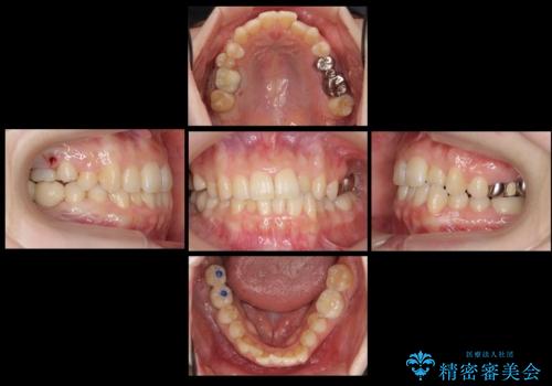 虫歯を放置 しっかり治療したい。 抜歯してインプラント治療の治療中