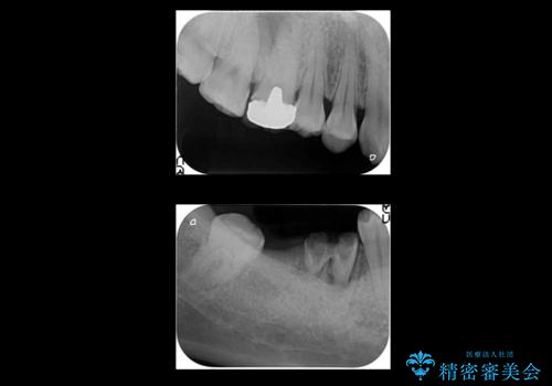 虫歯を放置 しっかり治療したい。 抜歯してインプラント治療の治療前