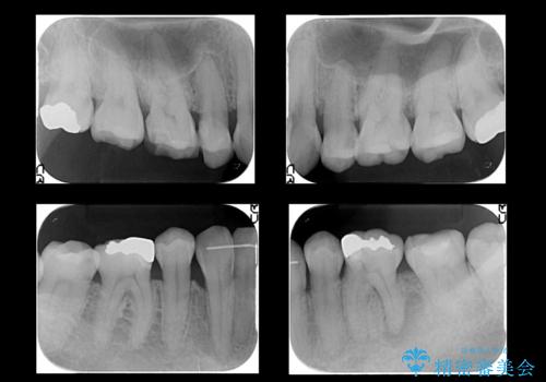 全体的な虫歯治療 の治療前