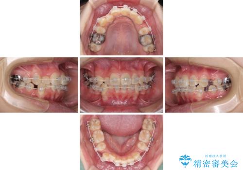 八重歯で正中が右にずれている ワイヤー装置での抜歯矯正で正中位置を改善の治療中