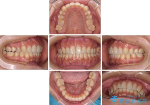 沖縄から飛行機で通院 インビザラインによる矯正治療の治療中