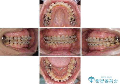 口元の出っ張りとデコボコを改善したいの治療中