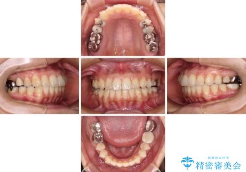 痛む奥歯と矯正の後戻り インビザライン・ライトとセラミック治療の治療中