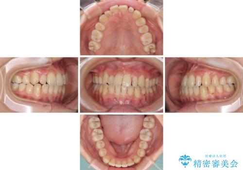 八重歯の抜歯矯正 補助装置を用いたインビザライン矯正の治療中