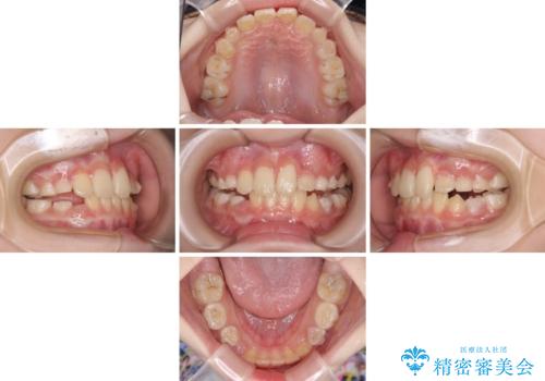 過剰歯を抜歯して前歯を排列 インビザライン・ファーストによる小学生のⅠ期治療の治療中