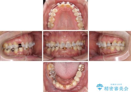 乳歯や矮小歯の多い前歯　部分矯正と補綴治療による審美歯科治療の治療中