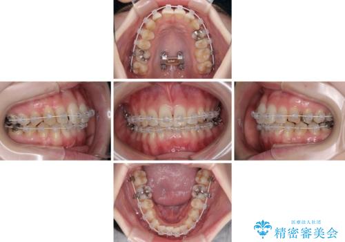 短期間での治療 急速拡大装置を併用したワイヤー装置による矯正治療の治療中