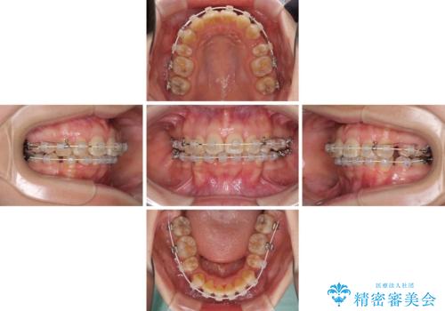 飛び出した前歯を引っ込めたい 目立たないワイヤーでの抜歯矯正の治療中