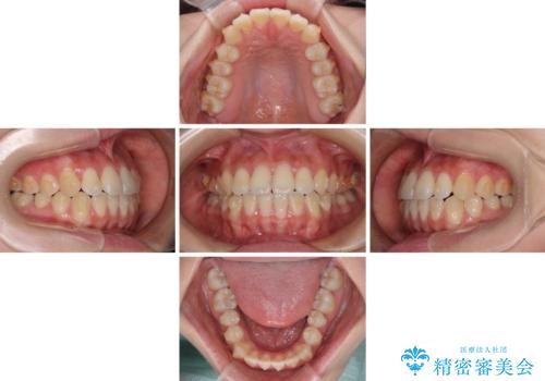 ワイヤー矯正を併用し、リスクを回避しながらのインビザライン矯正治療の治療中