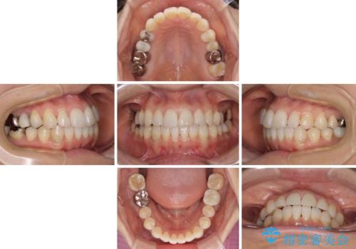 気になる前歯をインビザライン・ライトで 矯正治療後には銀歯をセラミックにの治療中