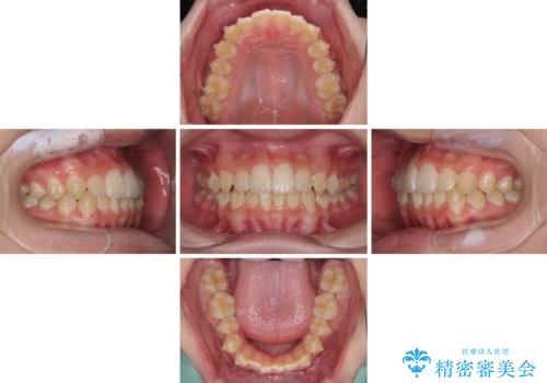 しっかり使って短期間で治療 インビザラインによる叢生解消の治療中