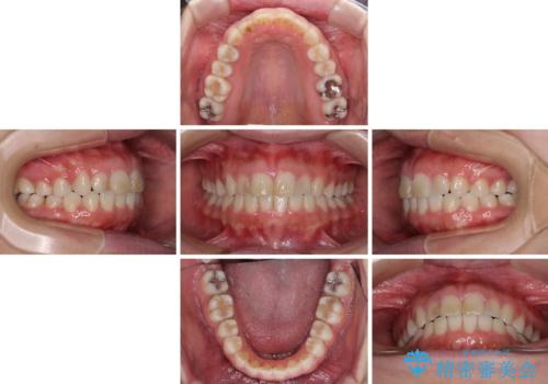 気になる前歯を治したい インビザラインで気づかれずに矯正治療の治療中