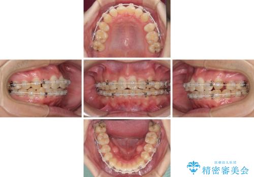 強い咬み込みですり減った前歯 デコボコを抜歯矯正で整えるの治療中