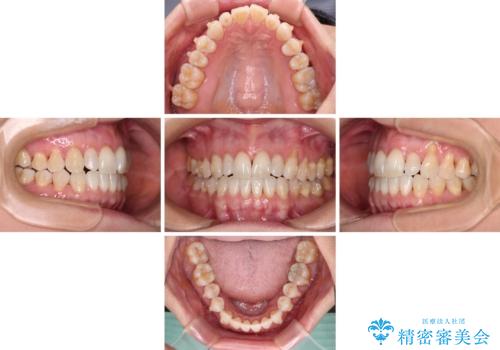 前歯のスペースが気になる インビザラインによる矯正治療の治療中