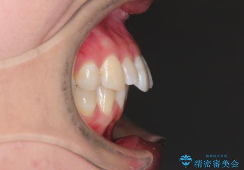 ワイヤー矯正とオールセラミックの組み合わせ治療の治療前
