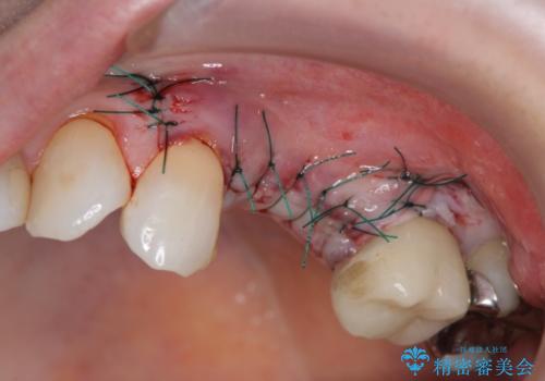 骨の造成を伴うインプラント治療の治療前